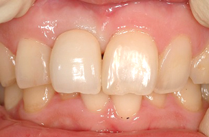 右上前歯の欠損症例　治療後