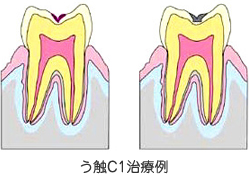 C1:虫歯のごく初期の状態