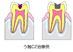 C2:虫歯が歯の組織に深く入り込んだ状態