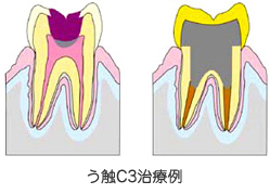 C3:虫歯がさらに進み、歯の中の神経まで達している状態