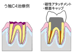 C4:歯の頭の部分が虫歯でなくなった状態