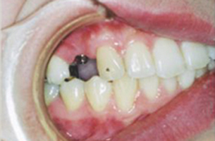 右上奥歯の欠損症例　治療前