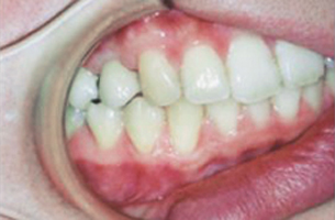 右上奥歯の欠損症例　治療後