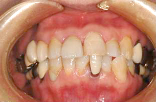前歯の欠損症例　治療後