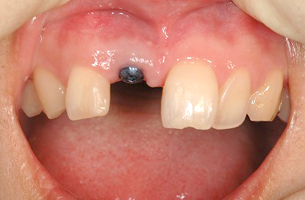 右上前歯の欠損症例　治療前