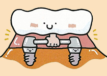 歯が全部抜けた場合　インプラント治療