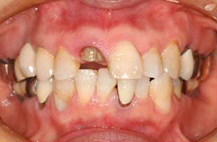 前歯の欠損症例　治療前